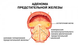 adenoma-predstatelnoj-zhelezy-e1446281824345